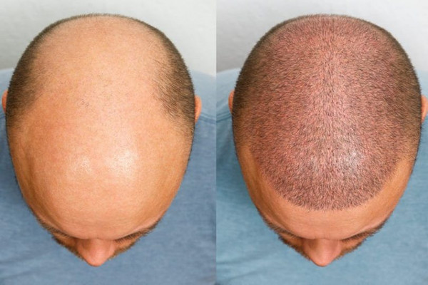 trapianto capelli